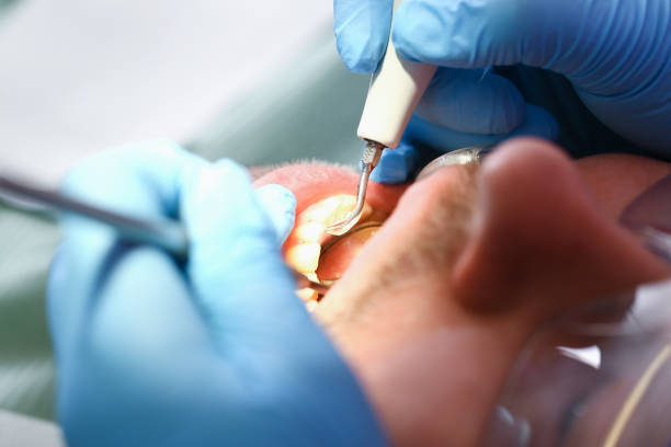 Best Emergency Dental Extractions in Schwenksville, PA