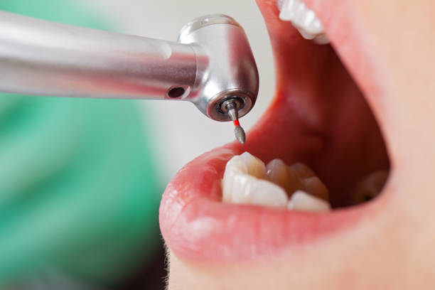 Best Broken or Cracked Tooth Emergency Dentist in Schwenksville, PA